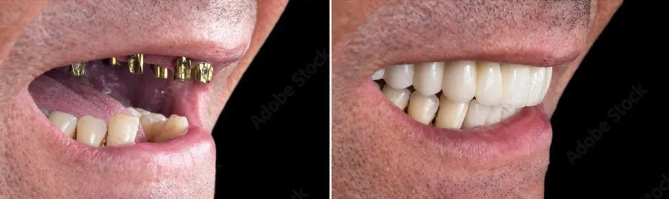 Dental Implants in Santa Rosa Beach, FL before and after