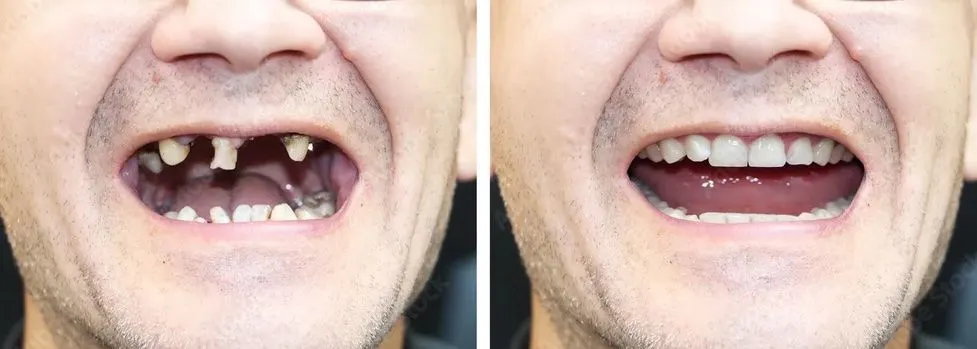 Dental Implants in Santa Rosa Beach, FL before and after