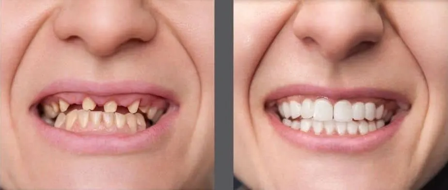 Dental Implants before and after
