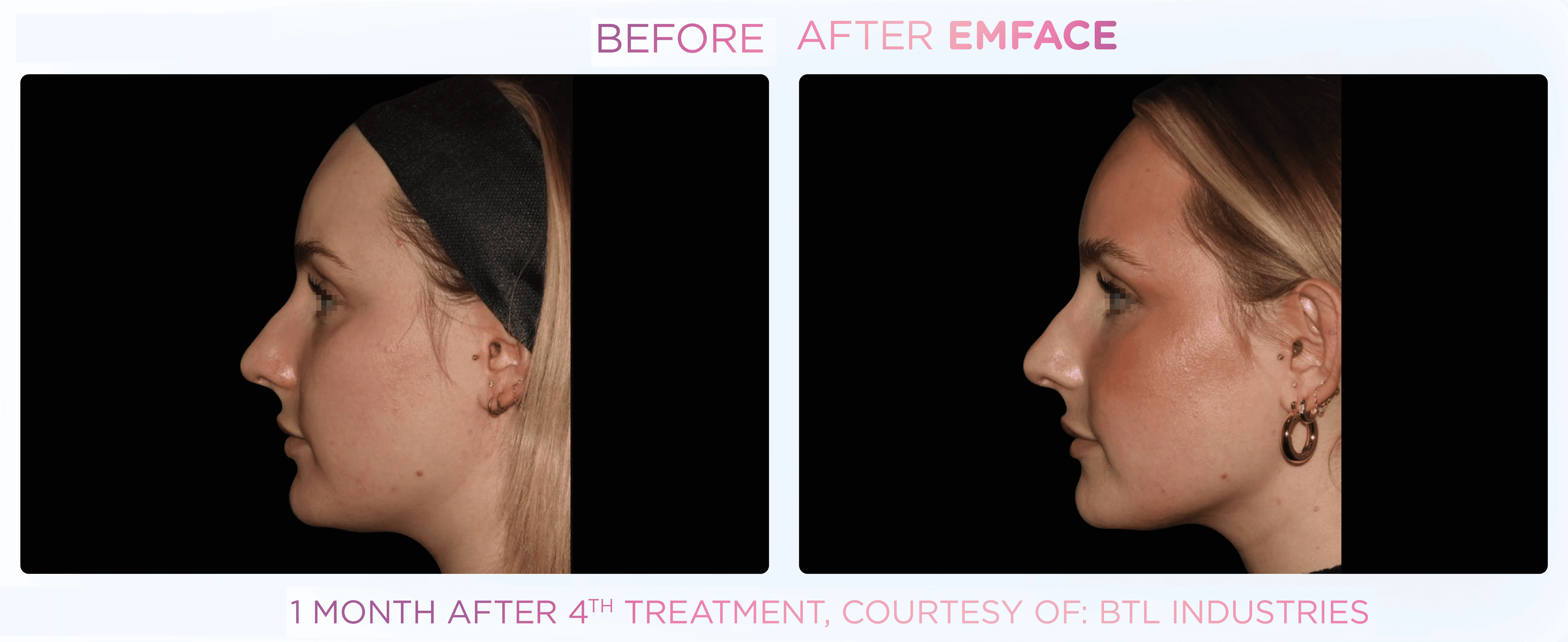 Emface in Santa Rosa Beach, FL before and after