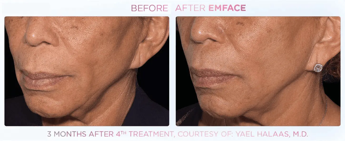 Emface before and after