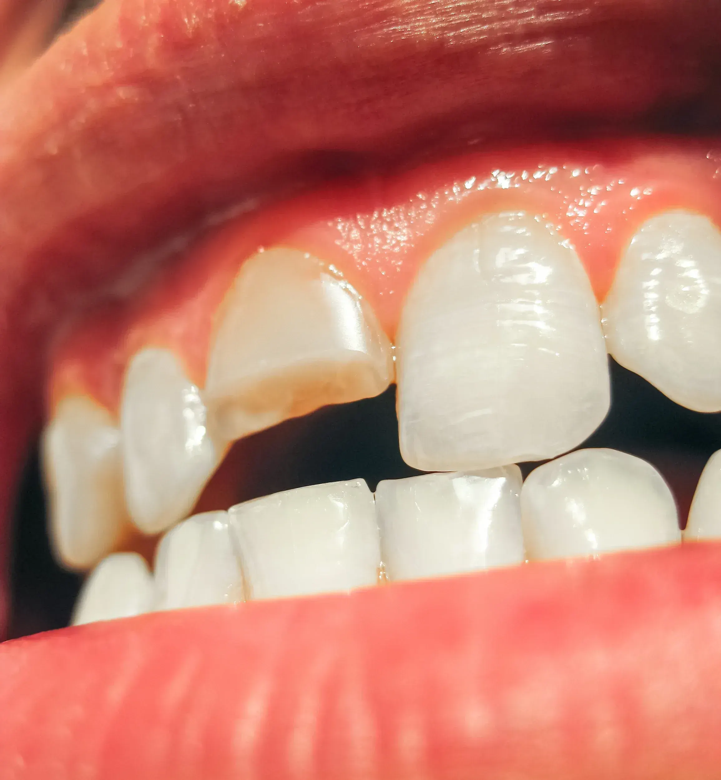 Close-up of a chipped front tooth before repair in Santa Rosa Beach, FL
