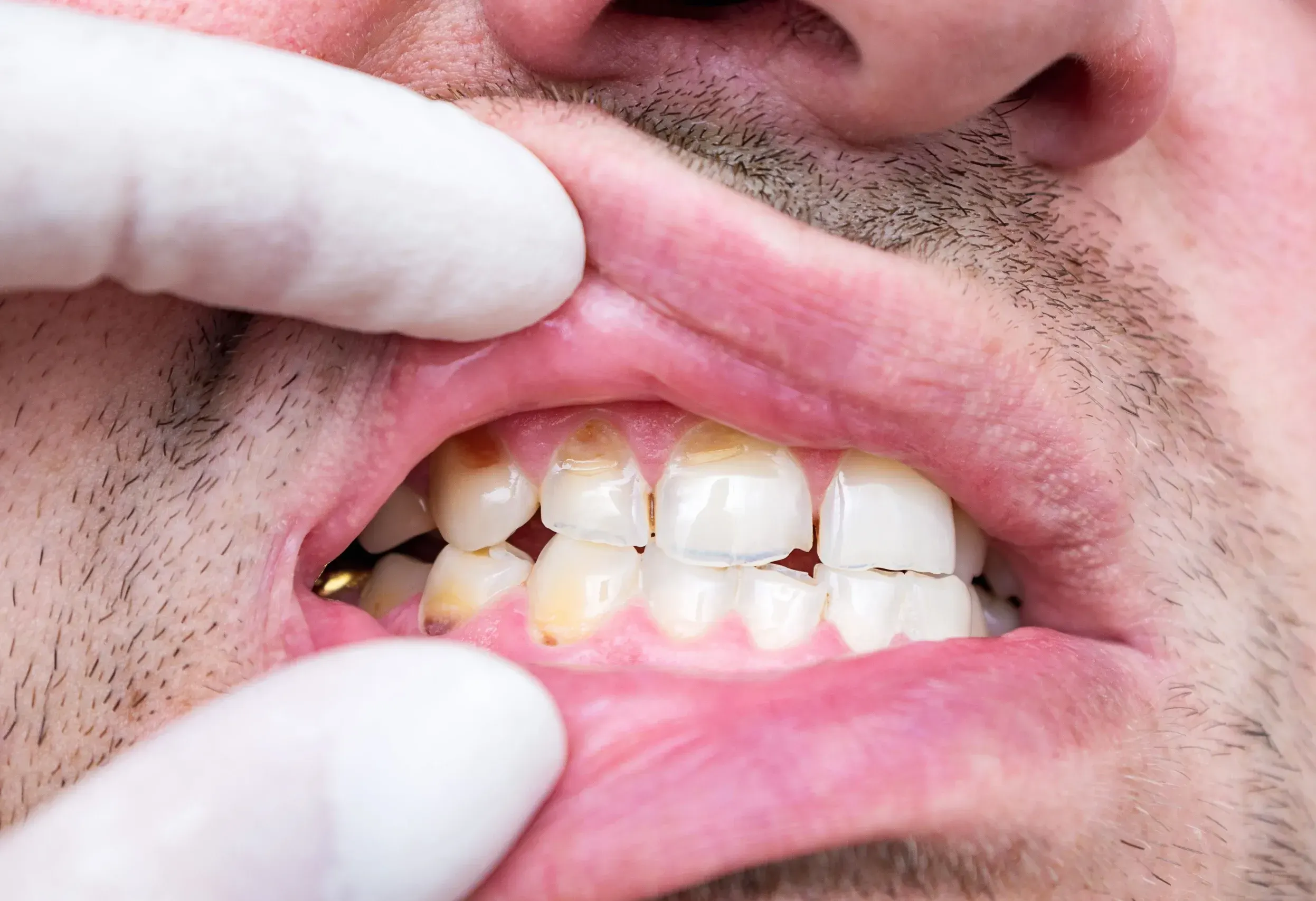 Dr. Cook reviewing X-rays with a patient about a cracked tooth