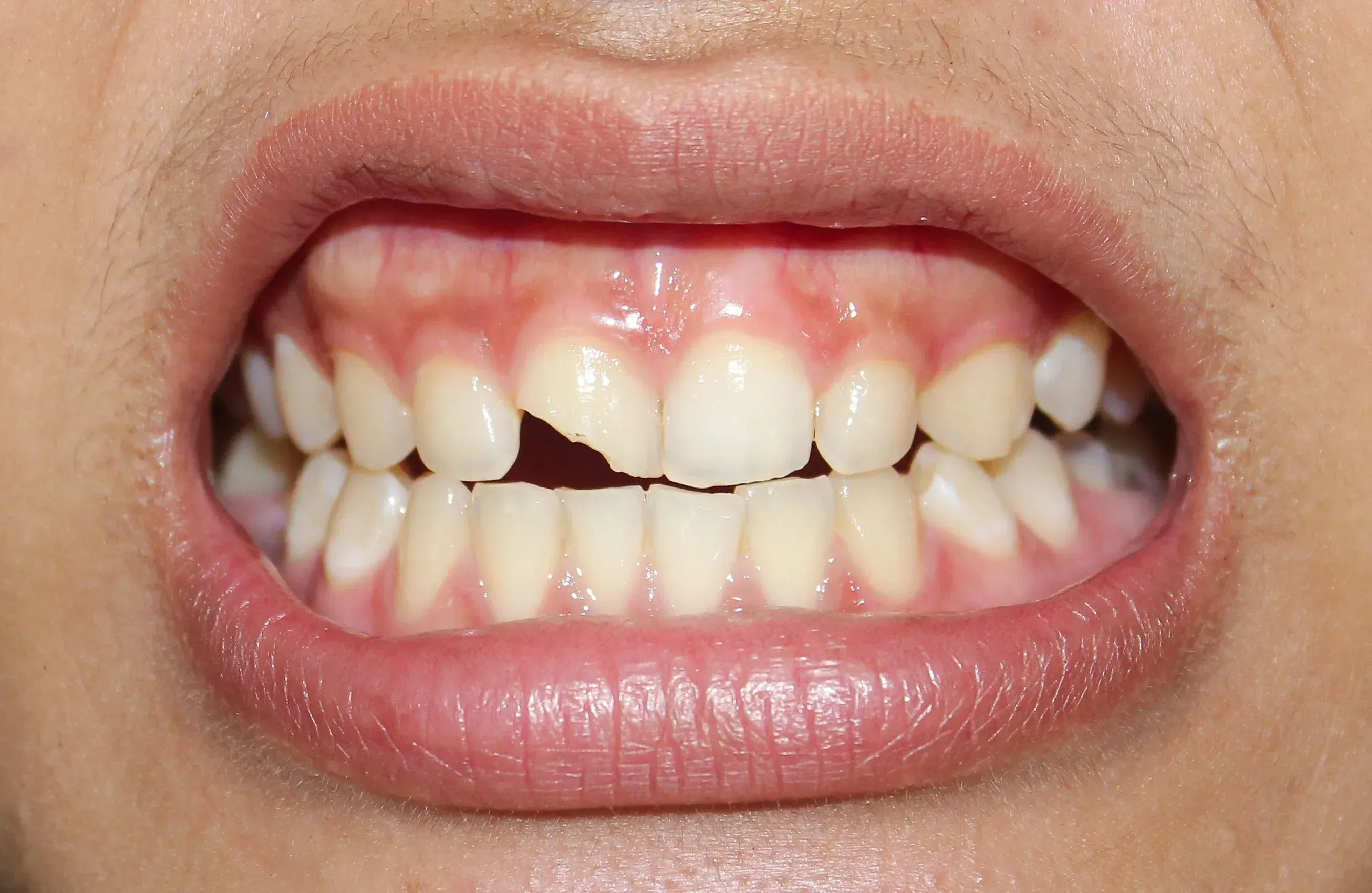 Patient pointing to area of mouth experiencing tooth pain on biting