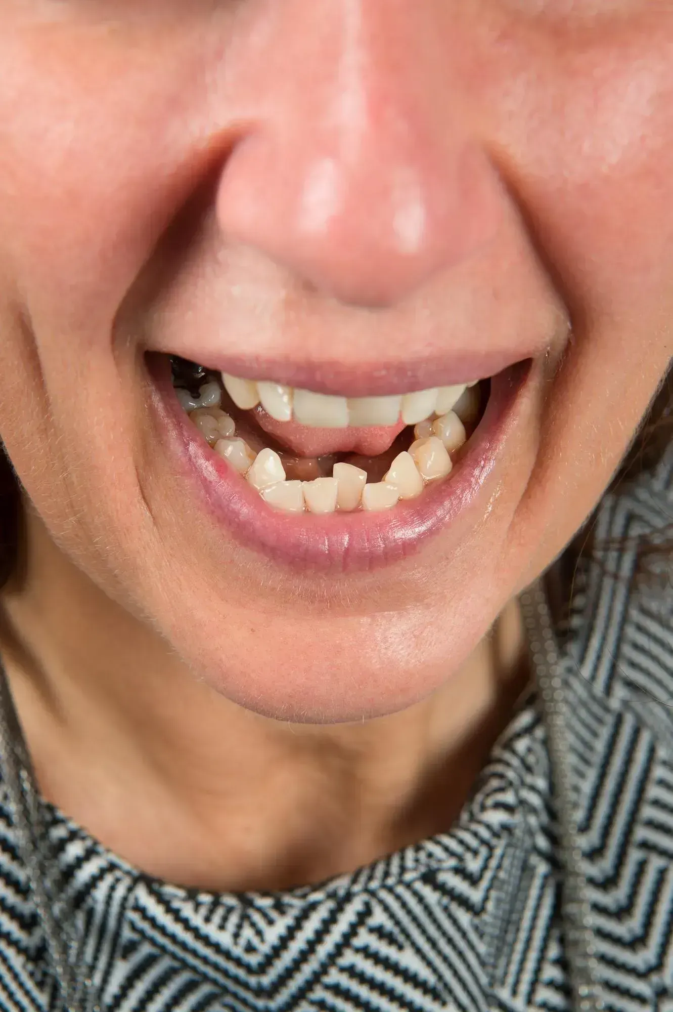 Close up of misaligned adult teeth being evaluated by dentist