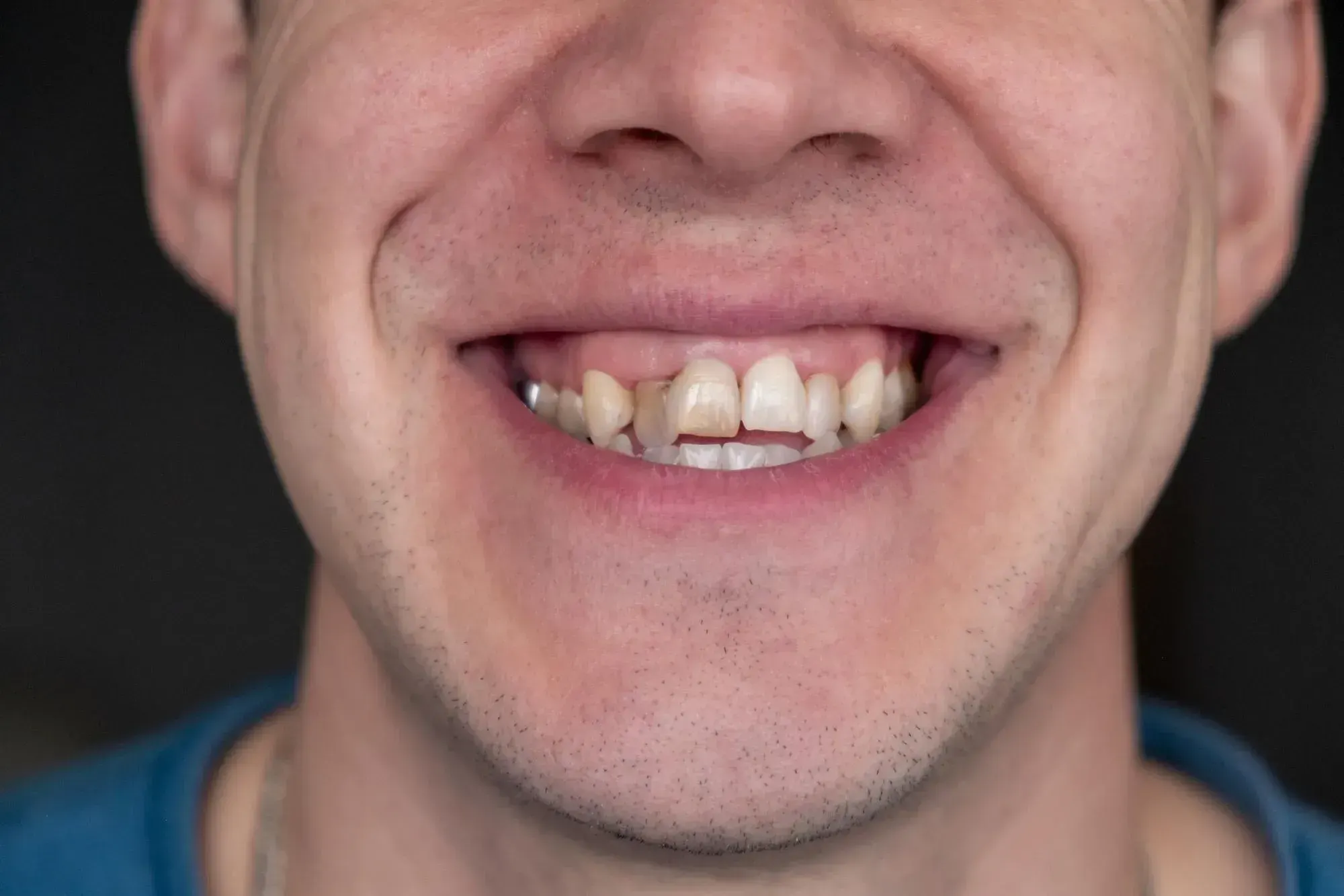 Adult patient examining their crooked teeth in a mirror