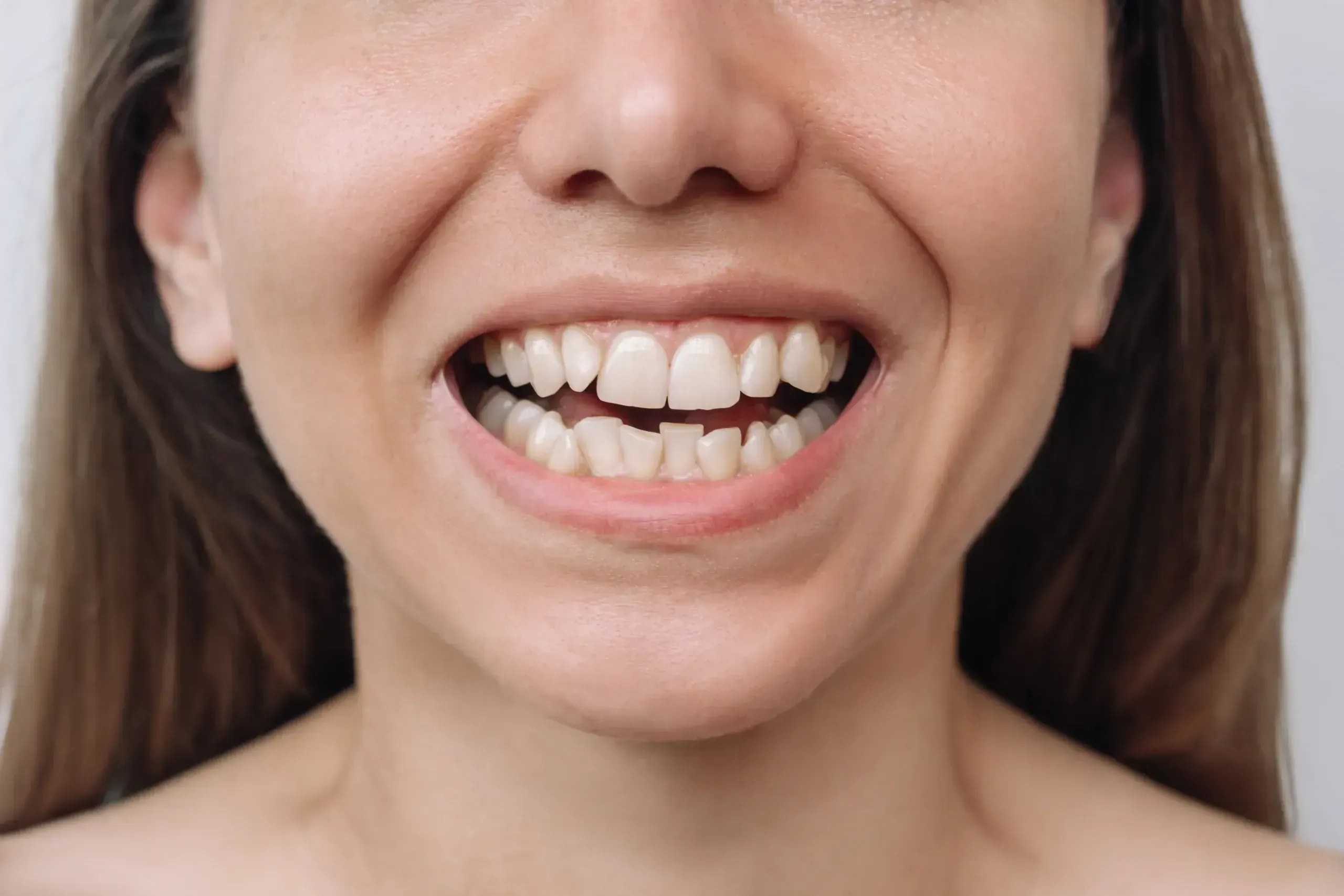 Adult patient smiling with straight teeth after orthodontic treatment in Santa Rosa Beach