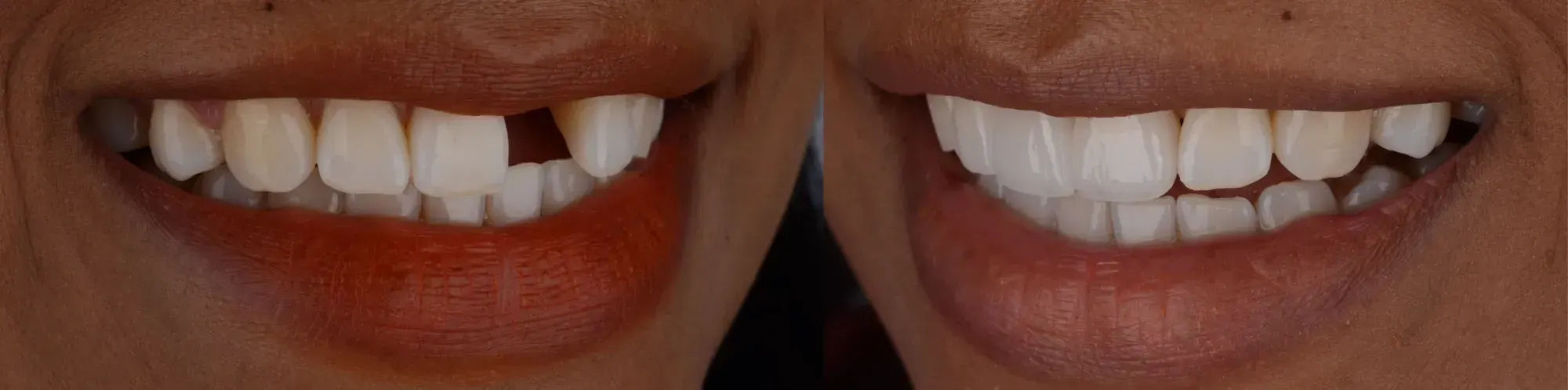 Dental Bridges in Santa Rosa Beach, FL before and after