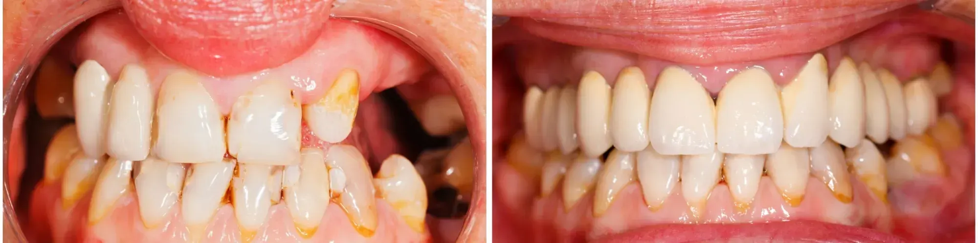 Dental Bridges before and after