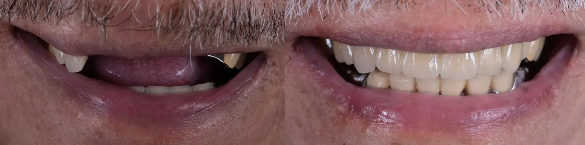 Dental Bridges in Santa Rosa Beach, FL before and after