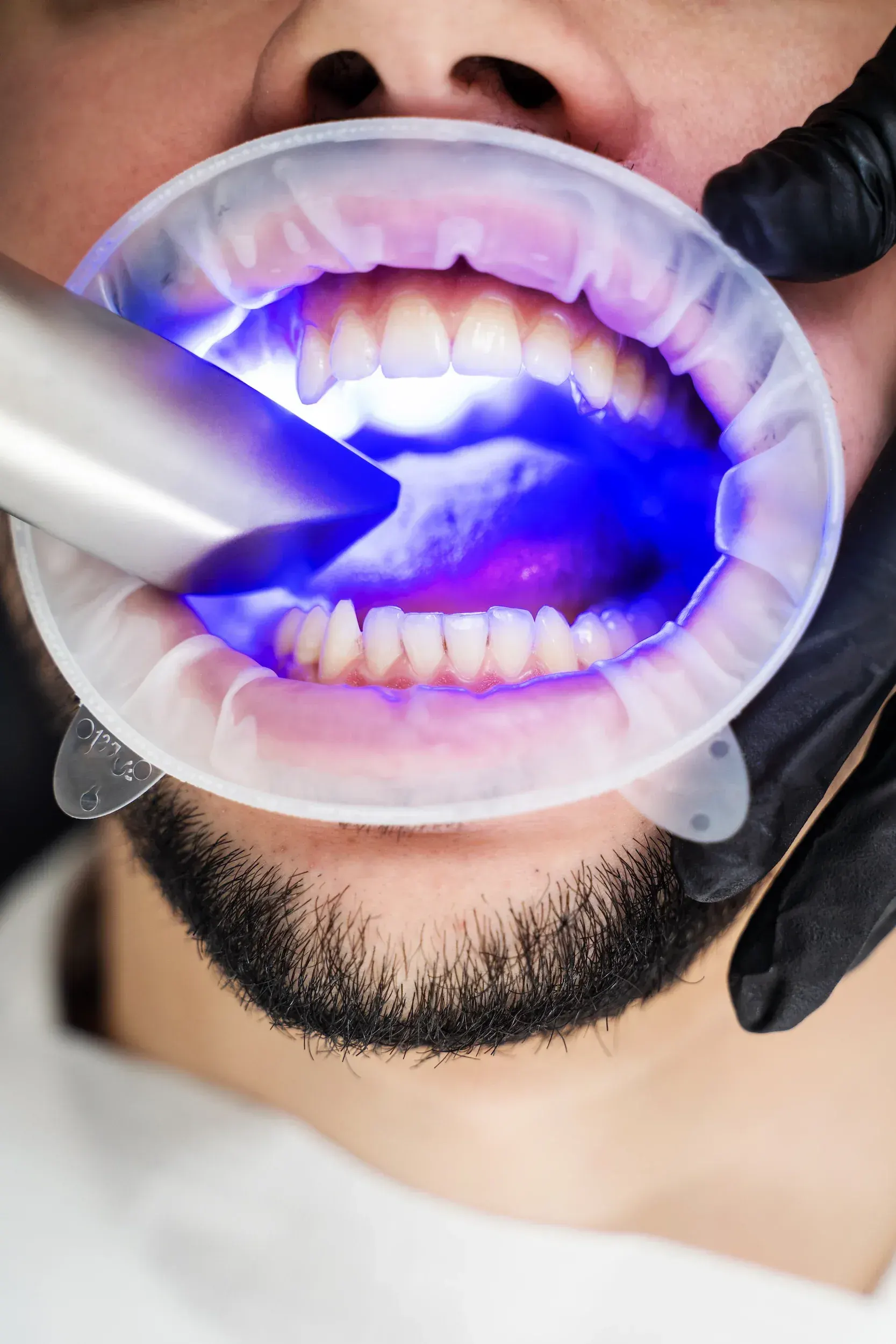 Close-up comparison of a healthy tooth and a tooth with early decay