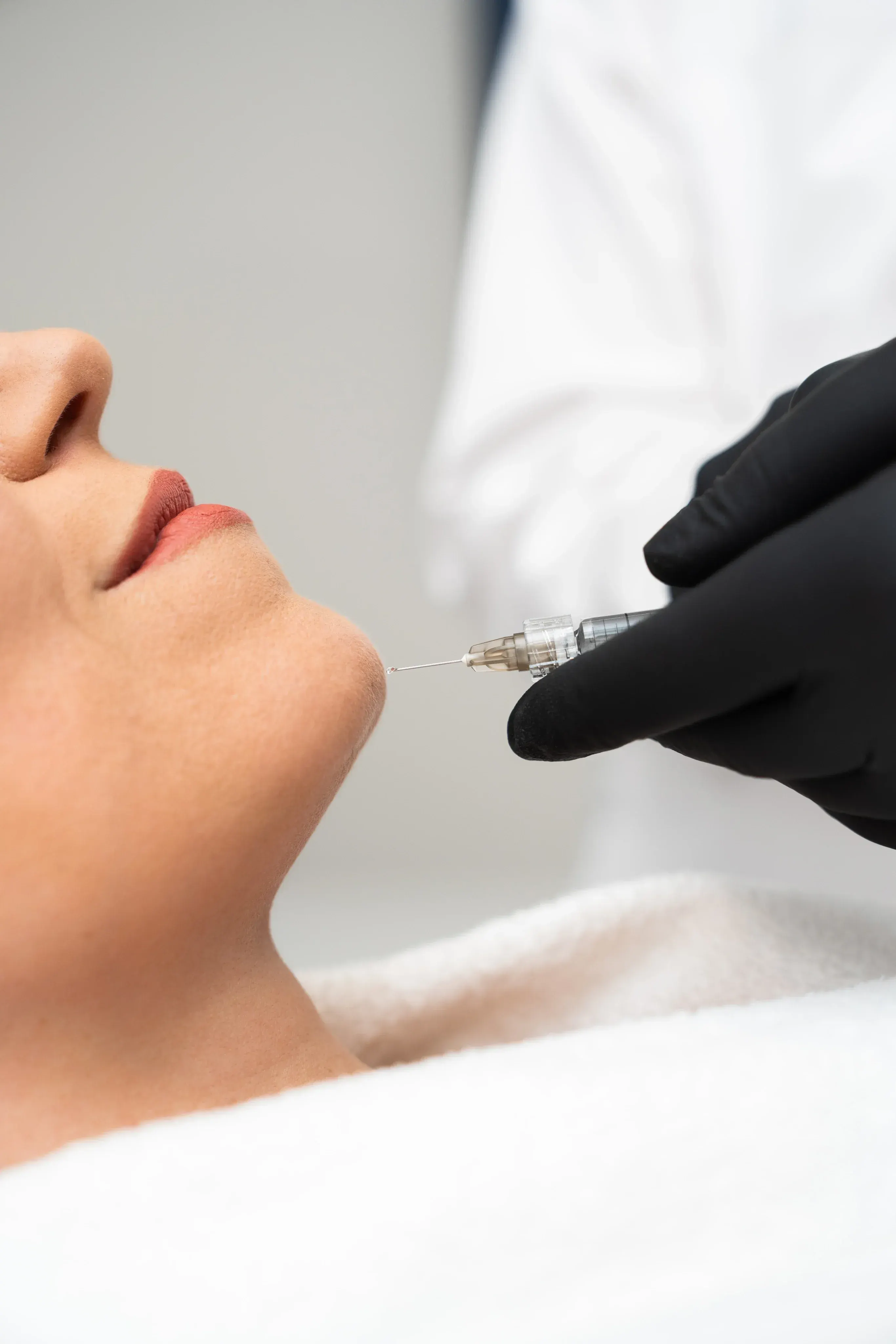 Refined facial contours after HA dermal filler treatment