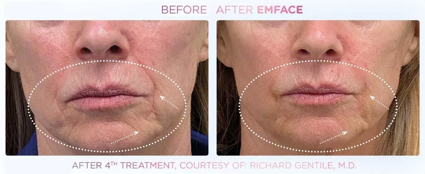 Emface in Santa Rosa Beach, FL before and after
