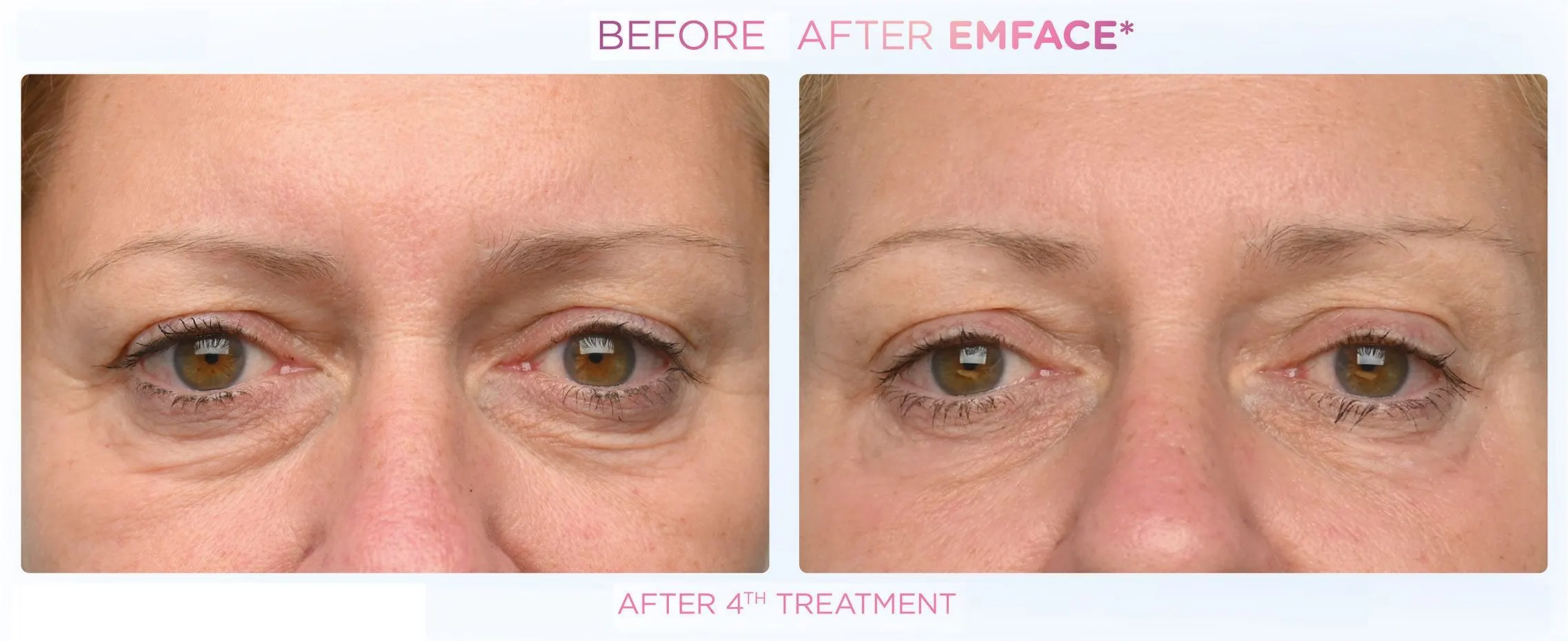 Emface in Santa Rosa Beach, FL before and after