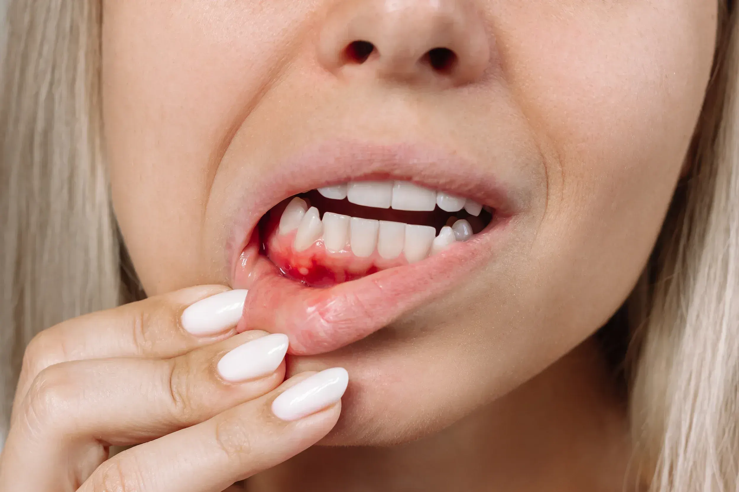 Gum Disease and Bleeding Gums