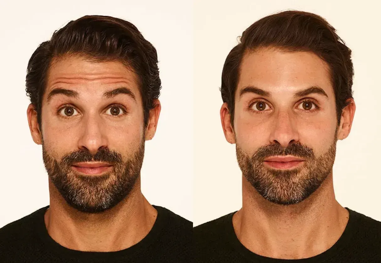 Botox in Santa Rosa Beach, FL before and after