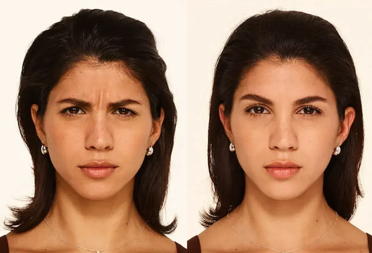Botox in Santa Rosa Beach, FL before and after
