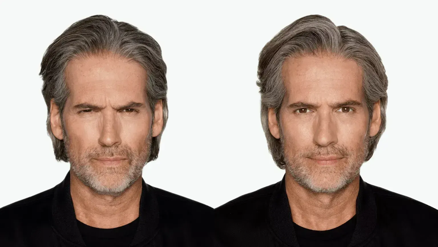 Botox before and after