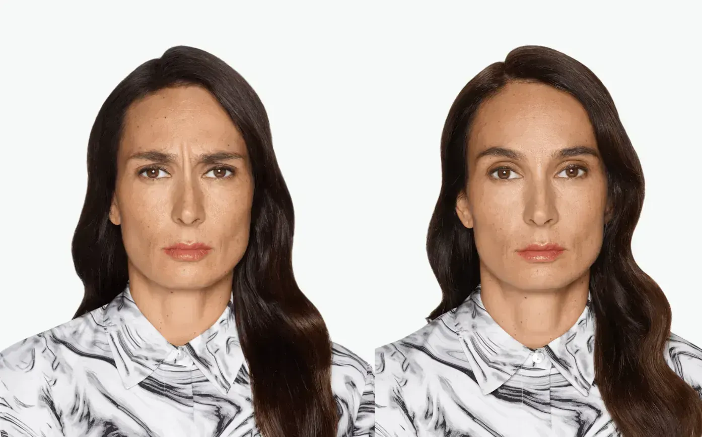 Botox in Santa Rosa Beach, FL before and after