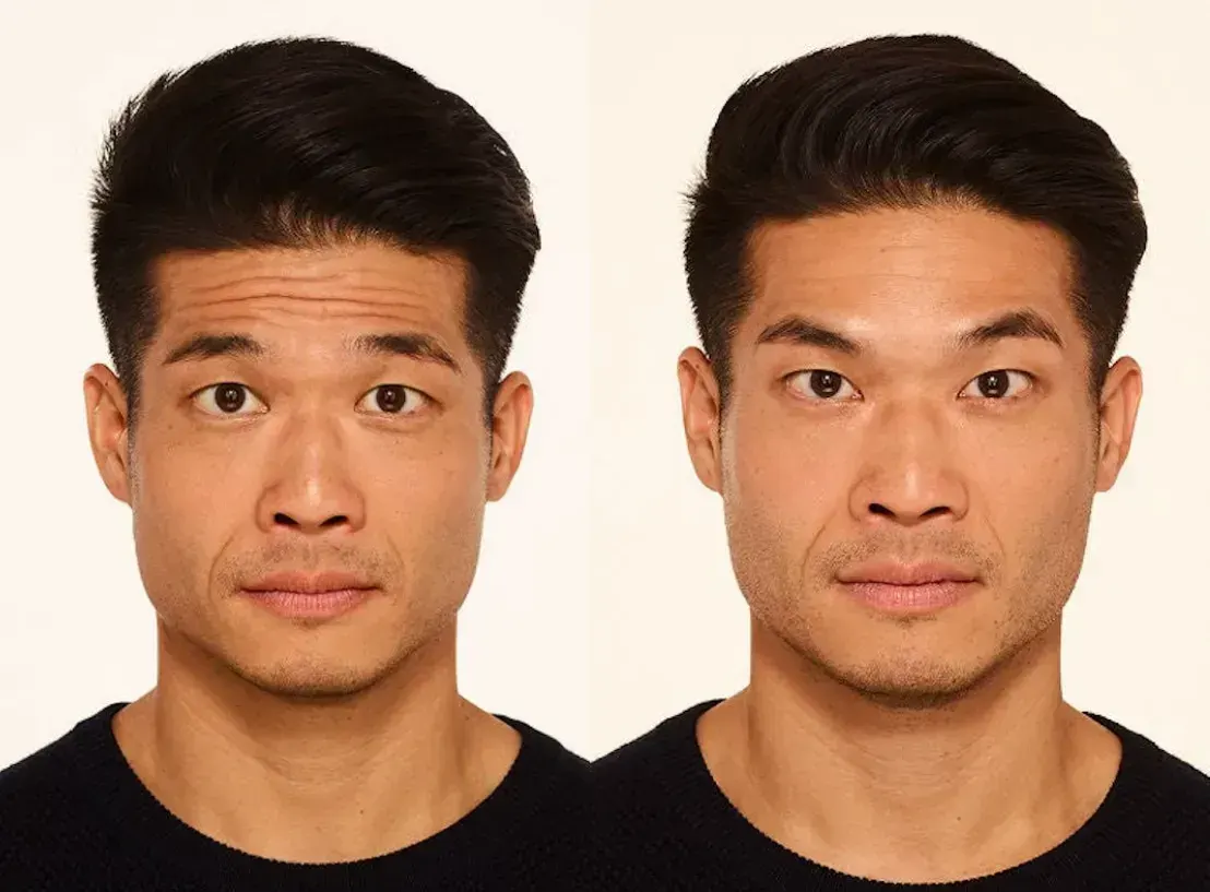 Botox in Santa Rosa Beach, FL before and after