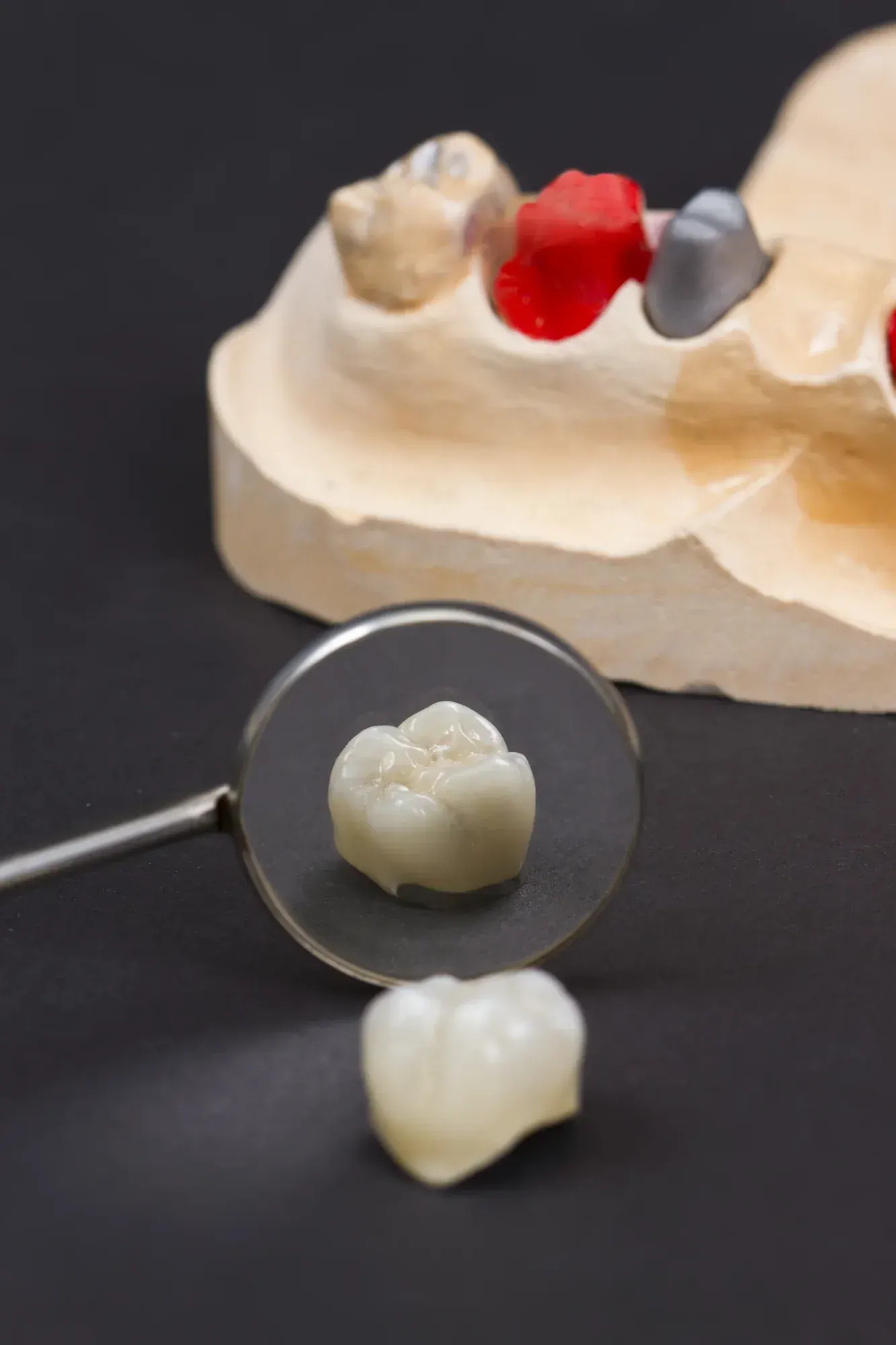 Side-by-side view of a healed dental implant and the same implant restored with a porcelain crown