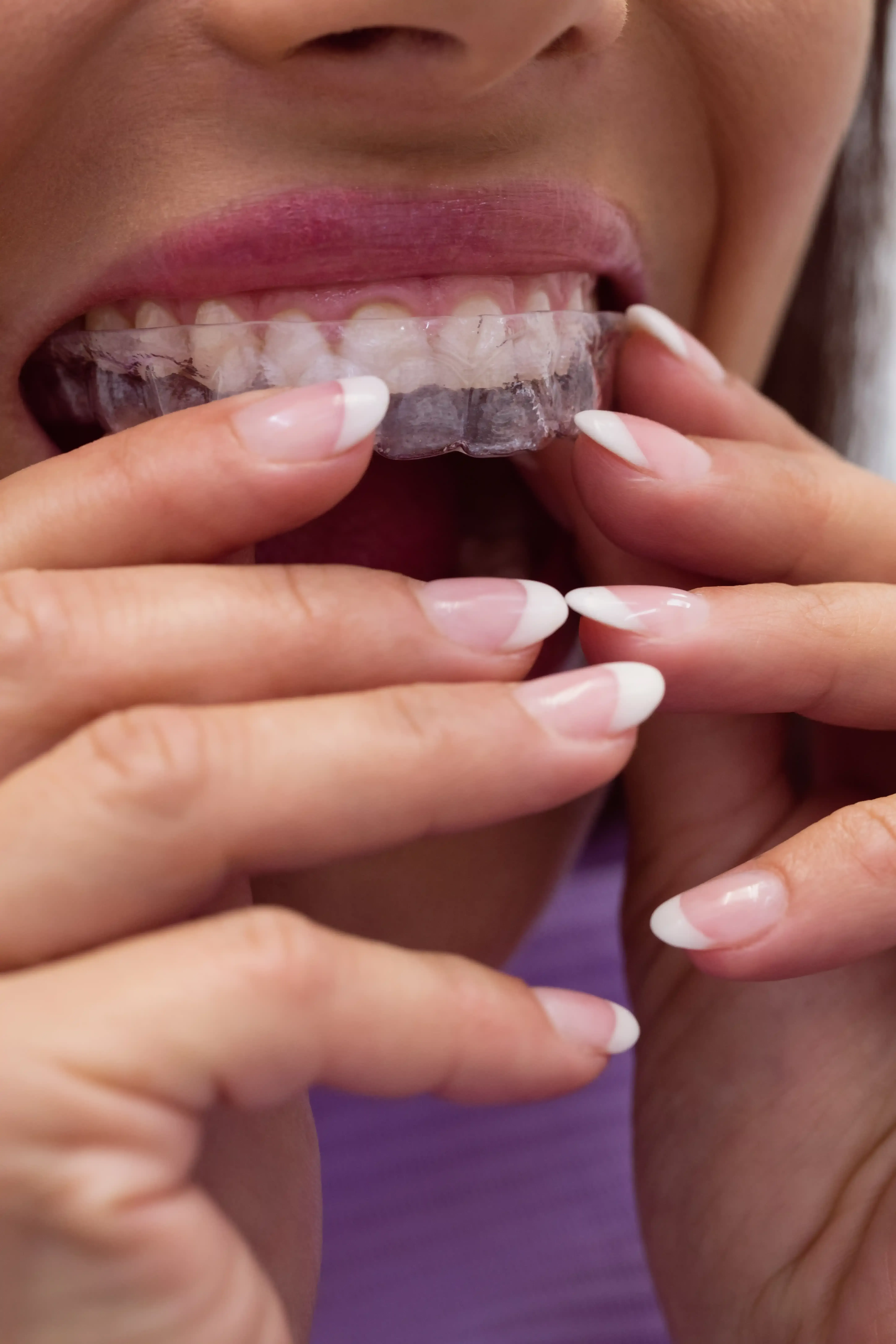 Close-up comparison of a smile before and after Invisalign treatment at Cook Family Dentistry
