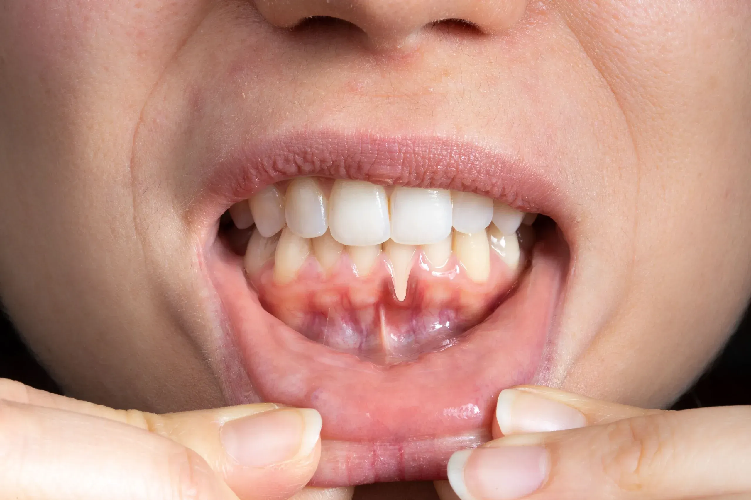 Receding Gums