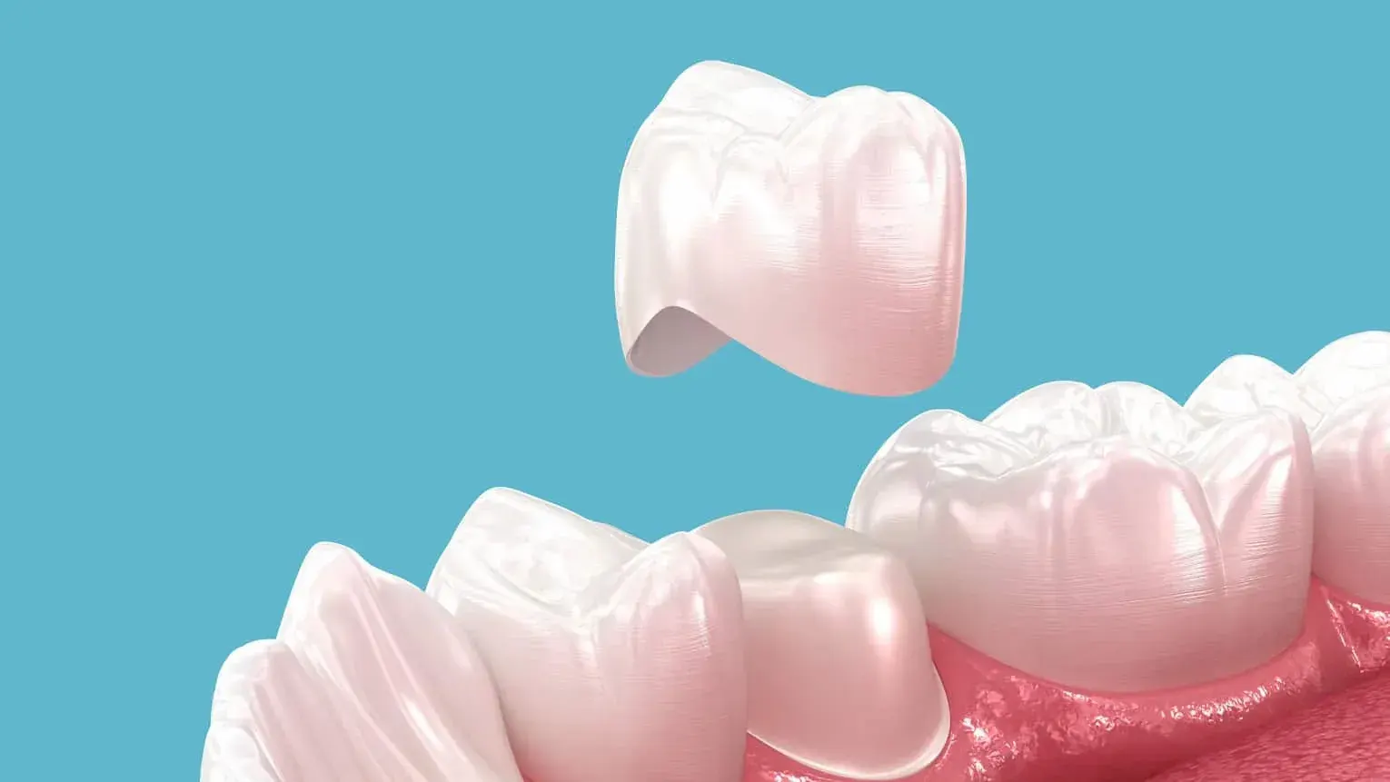 Side by side comparison of traditional crown impressions and CEREC digital scan