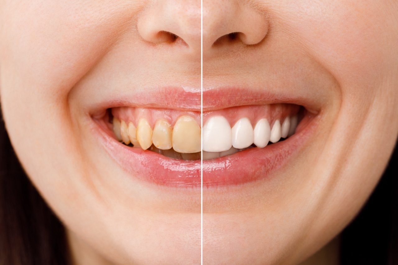 Teeth whitening — before and after